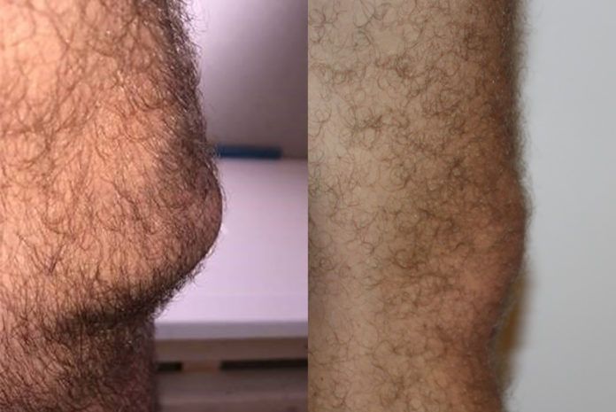 A comparison between a plumber’s knee (left) and that of an office worker